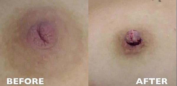 Inverted Nipple Correction - Audio Testimonial   Photos - Aurora Clinics